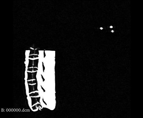 3D Slicer screenshot showing robot fiducial markers used for coordinate registration